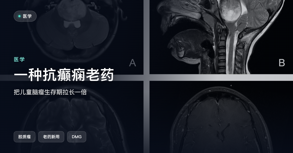 一种抗癫痫老药，把儿童脑瘤的生存期拉长了一倍
